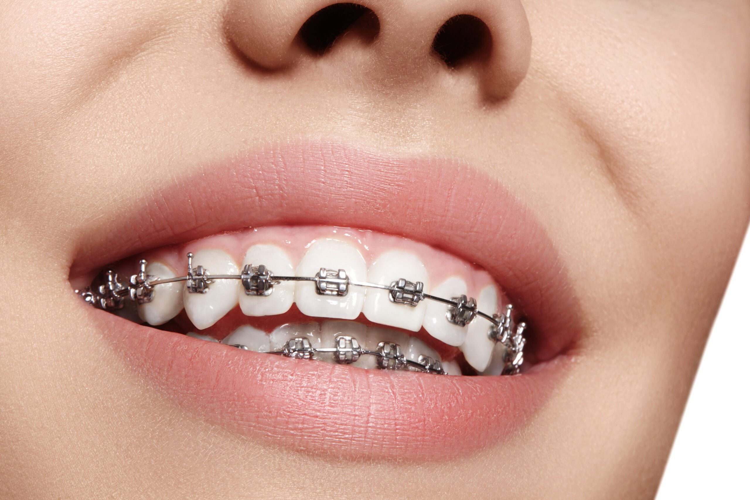 Paciente con brackets cerámicos en Clínica Dental SDent Vitoria-Gasteiz